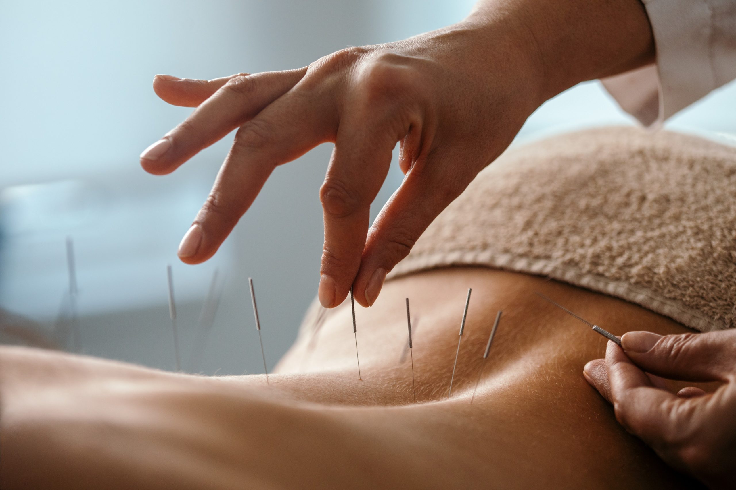 dry needles